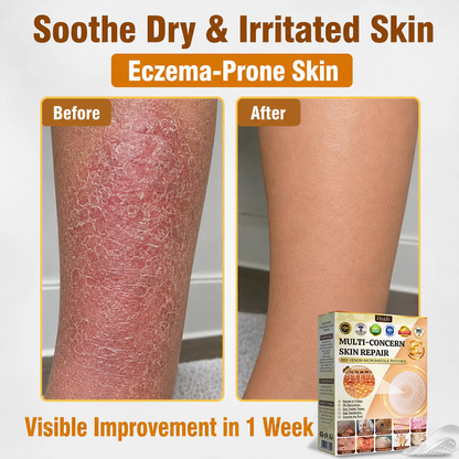 💜Hiskin ®MULTI-CONCERN SKIN REPAIR BEE VENOM MICRONEEDLE PATCHES