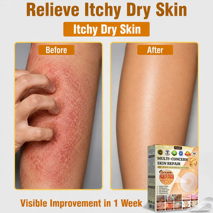 💜Hiskin ®MULTI-CONCERN SKIN REPAIR BEE VENOM MICRONEEDLE PATCHES