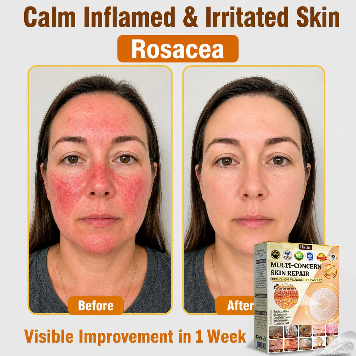 💜Hiskin ®MULTI-CONCERN SKIN REPAIR BEE VENOM MICRONEEDLE PATCHES