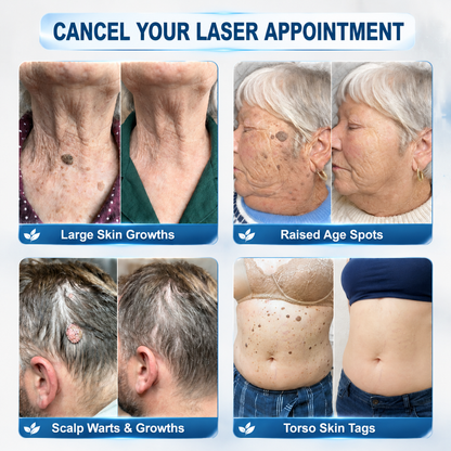 🔖𝖧𝖨𝖲𝖪𝖨𝖭®👩‍⚕️⭐ 𝟕-𝐃𝒂𝘆 𝐒𝗸𝐢𝐧 𝐓𝒂𝗴 & 𝐒𝐩𝙤𝐭 𝐄𝐫𝒂𝐬𝙚𝐫 Painless & Scar-Free Advanced Imperfection Removal Rollerball Pen