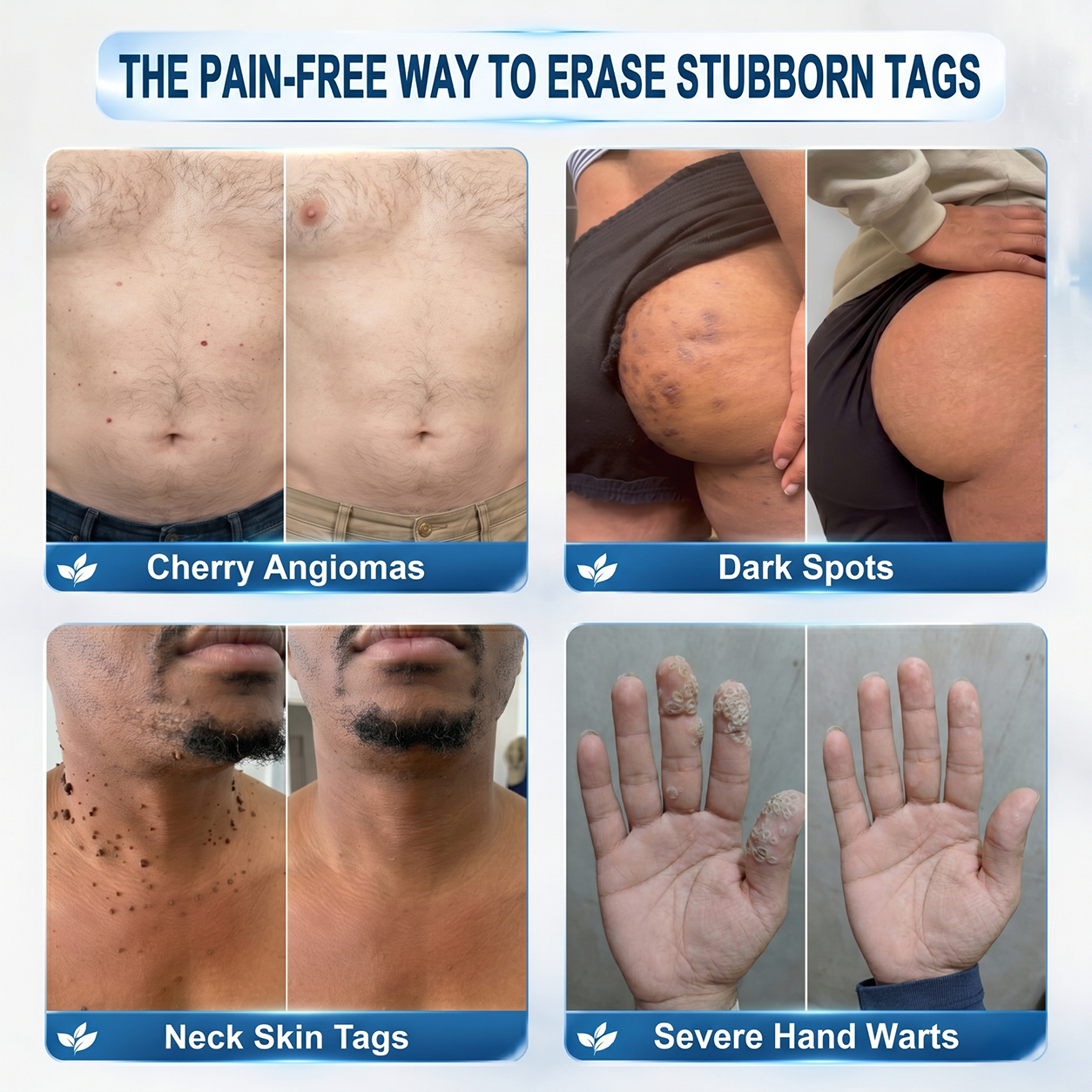🏷️𝐇𝐈𝐒𝐊𝐈𝐍®👩‍⚕️ 𝟕-𝐃𝒂𝘆 𝐒𝗸𝐢𝐧 𝐓𝒂𝗴 & 𝐒𝐩𝙤𝐭 𝐄𝐫𝒂𝐬𝙚𝐫 Painless & Scar-Free Advanced Imperfection Removal Rollerball Pen