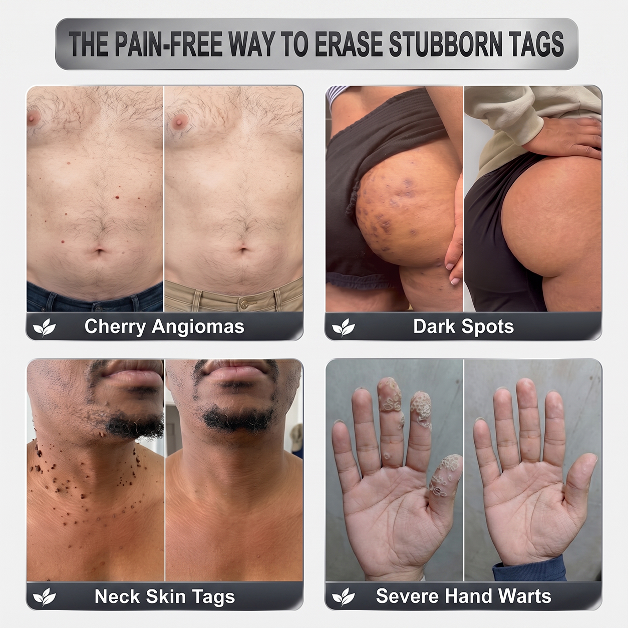NEW 𝖧𝖨𝖲𝖪𝖨𝖭®👩‍⚕️⭐ 𝟕-𝐃𝒂𝘆 𝐒𝗸𝐢𝐧 𝐓𝒂𝗴 & 𝐒𝐩𝙤𝐭 𝐄𝐫𝒂𝐬𝙚𝐫 Painless & Scar-Free Advanced Imperfection Removal Rollerball Pen