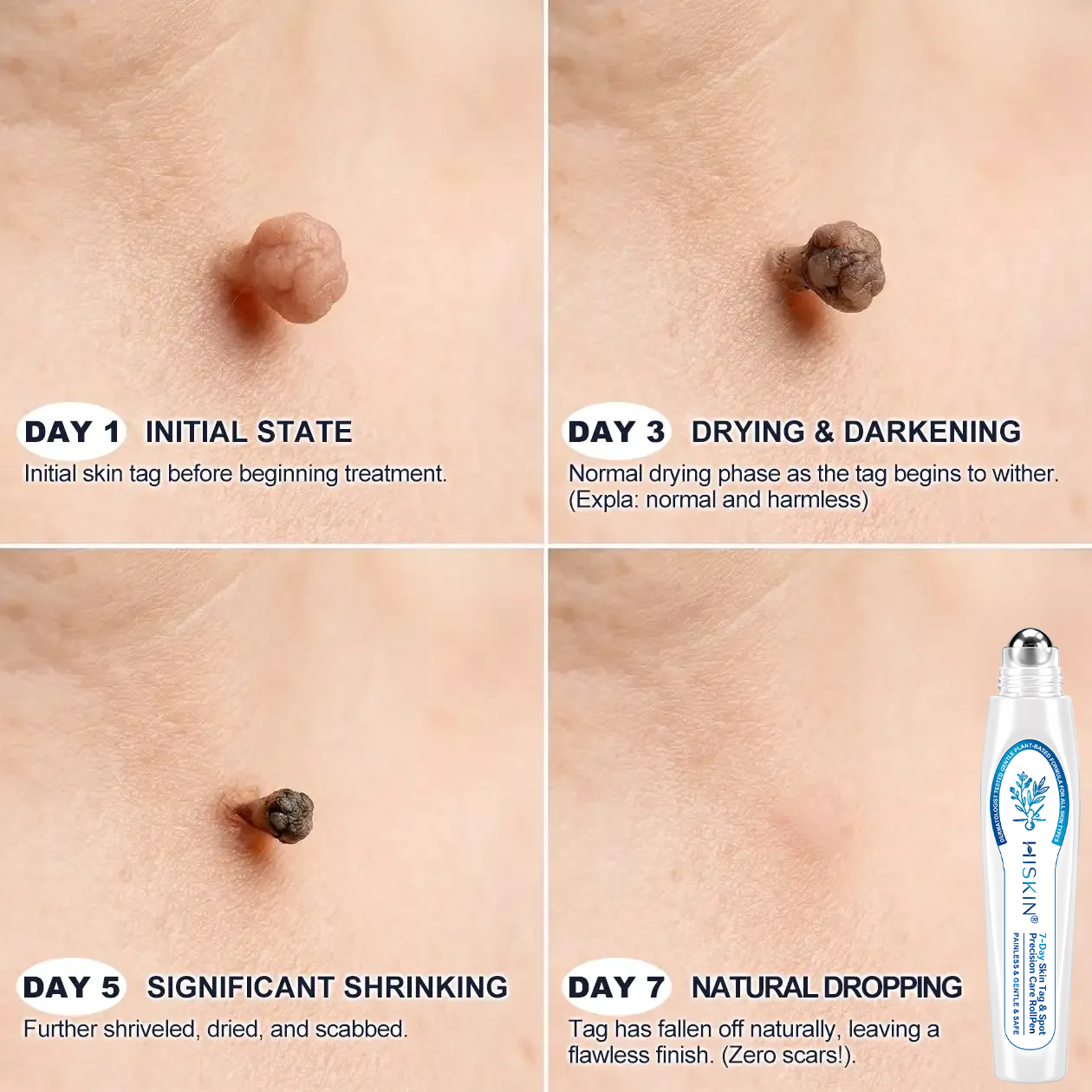 🔖𝖧𝖨𝖲𝖪𝖨𝖭®👩‍⚕️⭐ 𝟕-𝐃𝒂𝘆 𝐒𝗸𝐢𝐧 𝐓𝒂𝗴 & 𝐒𝐩𝙤𝐭 𝐄𝐫𝒂𝐬𝙚𝐫 Painless & Scar-Free Advanced Imperfection Removal Rollerball Pen