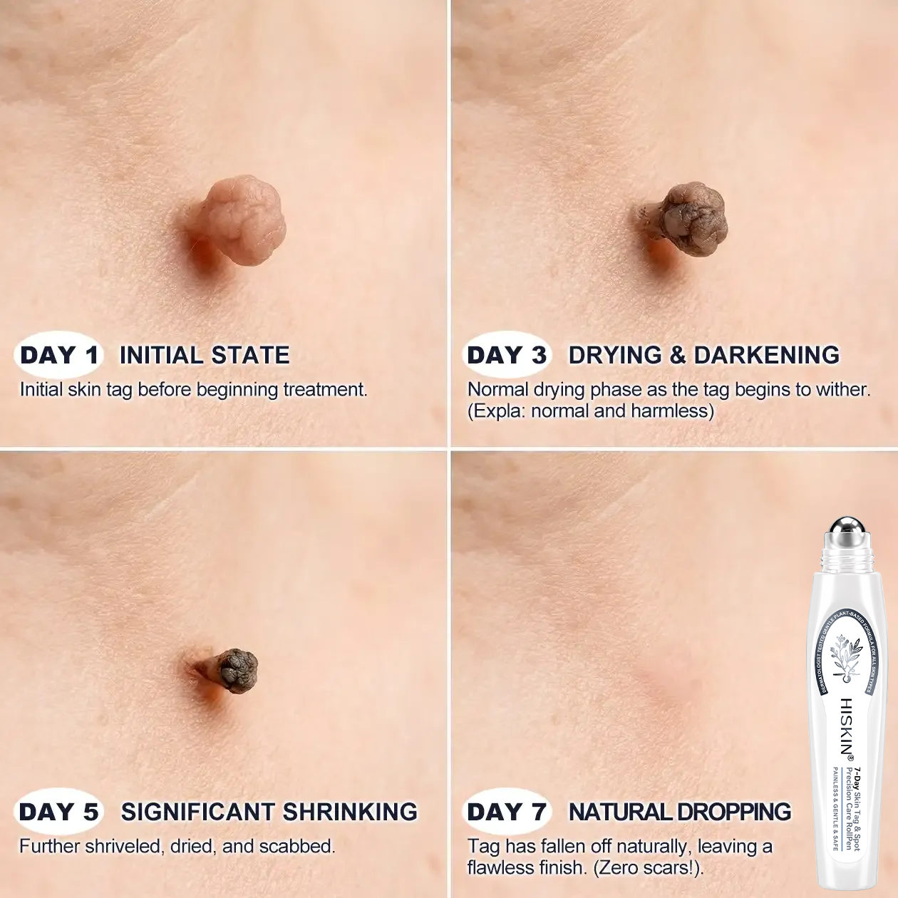 NEW 𝖧𝖨𝖲𝖪𝖨𝖭®👩‍⚕️⭐ 𝟕-𝐃𝒂𝘆 𝐒𝗸𝐢𝐧 𝐓𝒂𝗴 & 𝐒𝐩𝙤𝐭 𝐄𝐫𝒂𝐬𝙚𝐫 Painless & Scar-Free Advanced Imperfection Removal Rollerball Pen