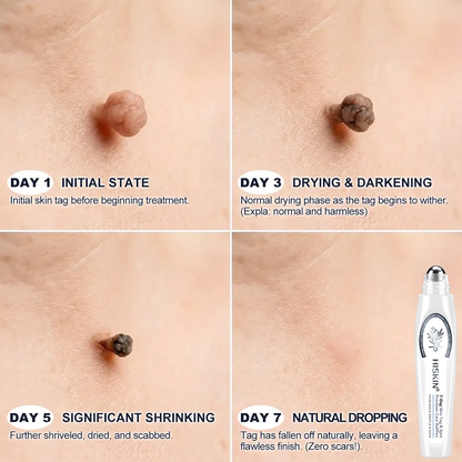 NEW 𝖧𝖨𝖲𝖪𝖨𝖭®👩‍⚕️⭐ 𝟕-𝐃𝒂𝘆 𝐒𝗸𝐢𝐧 𝐓𝒂𝗴 & 𝐒𝐩𝙤𝐭 𝐄𝐫𝒂𝐬𝙚𝐫 Painless & Scar-Free Advanced Imperfection Removal Rollerball Pen