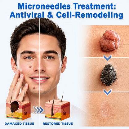 💝Hiskin ® 2-in-1 Microneedle & Hydrocolloid Patch🍀 | Removes raised moles, acne, flat warts, and skin tags | Helps improve wrinkles, scars, and blemishes | Invisible patches for face and body
