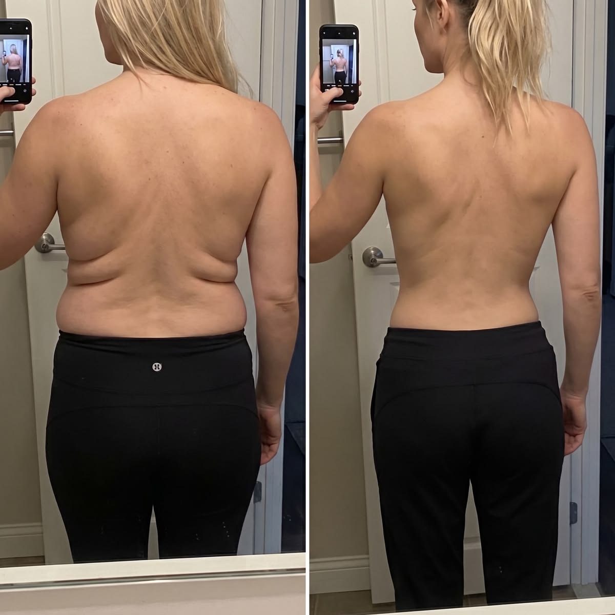 ❣️HISKIN® BREAST ENHANCEMENT  LIFT & FIRM MICRONEEDLE PATCHES