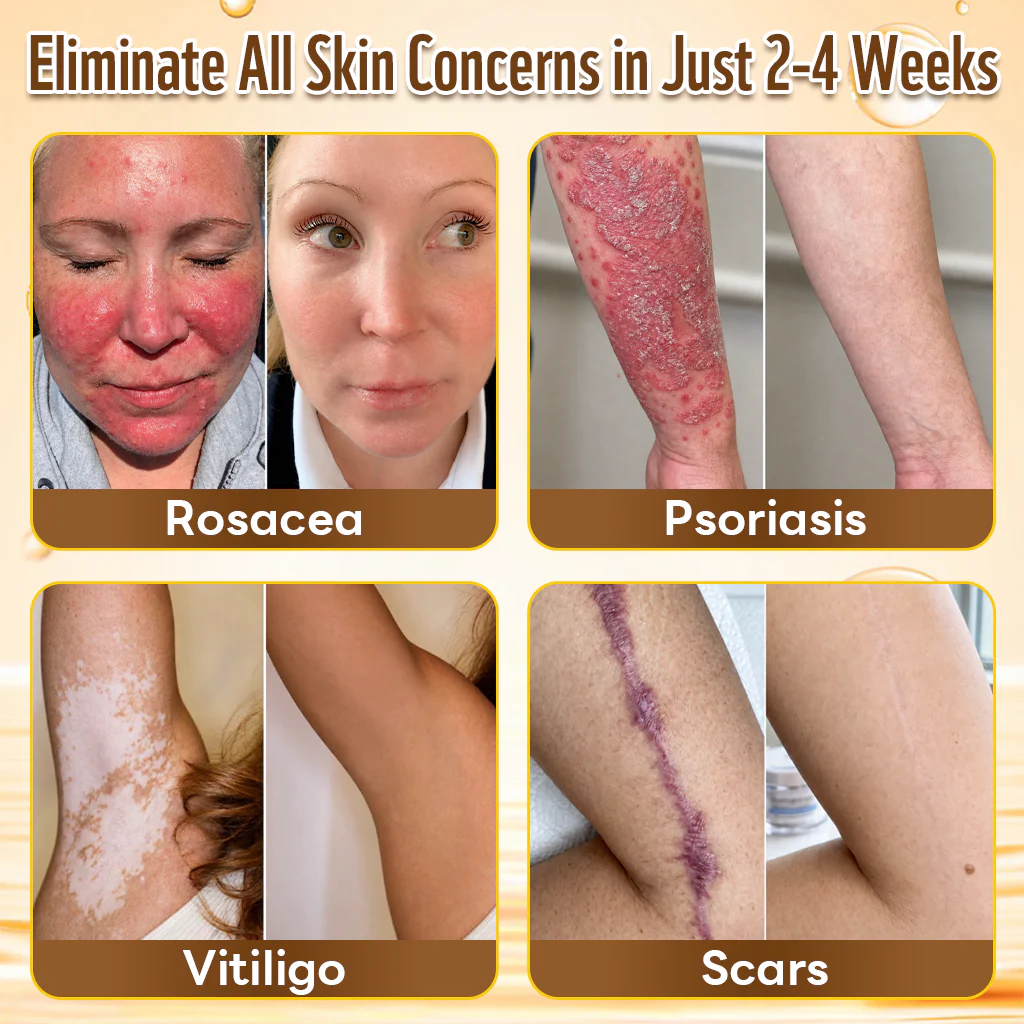 💜Hiskin ®MULTI-CONCERN SKIN REPAIR BEE VENOM MICRONEEDLE PATCHES