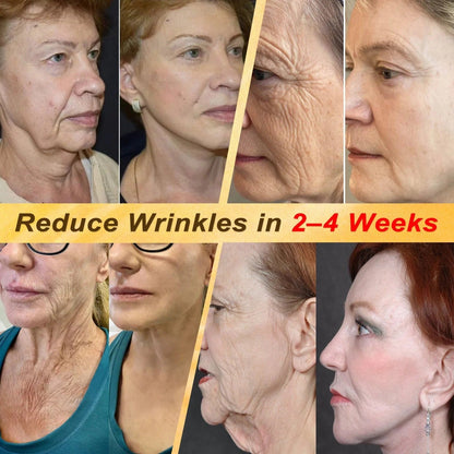 💜Hiskin ®MULTI-CONCERN SKIN REPAIR BEE VENOM MICRONEEDLE PATCHES