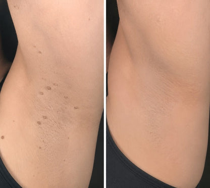 💝Hiskin ® 2-in-1 Microneedle & Hydrocolloid Patch🍀 | Removes raised moles, acne, flat warts, and skin tags | Helps improve wrinkles, scars, and blemishes | Invisible patches for face and body