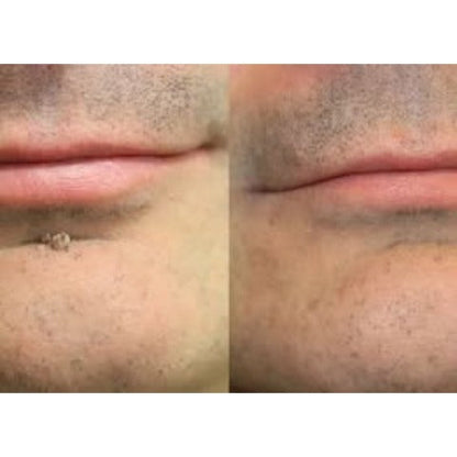 💝Hiskin ® 2-in-1 Microneedle & Hydrocolloid Patch🍀 | Removes raised moles, acne, flat warts, and skin tags | Helps improve wrinkles, scars, and blemishes | Invisible patches for face and body