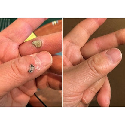 💝Hiskin ® 2-in-1 Microneedle & Hydrocolloid Patch🍀 | Removes raised moles, acne, flat warts, and skin tags | Helps improve wrinkles, scars, and blemishes | Invisible patches for face and body