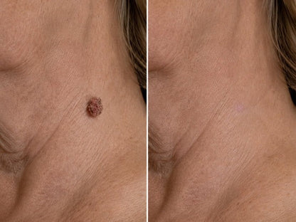 💝Hiskin ® 2-in-1 Microneedle & Hydrocolloid Patch🍀 | Removes raised moles, acne, flat warts, and skin tags | Helps improve wrinkles, scars, and blemishes | Invisible patches for face and body