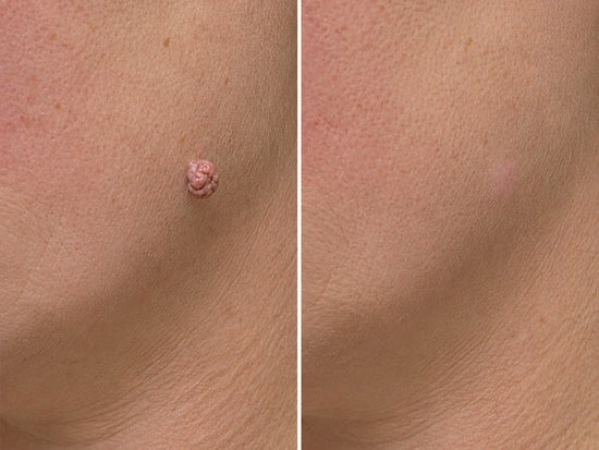 💝Hiskin ® 2-in-1 Microneedle & Hydrocolloid Patch🍀 | Removes raised moles, acne, flat warts, and skin tags | Helps improve wrinkles, scars, and blemishes | Invisible patches for face and body